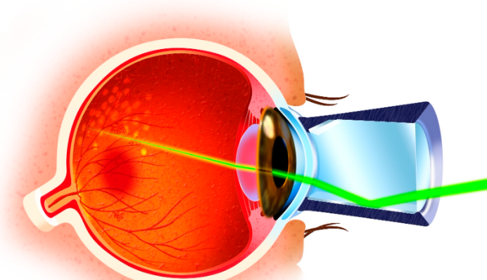 黄斑水肿手术后可以提高视力吗?黄斑病情稳定的情况下进行手术才有机会提高视力 