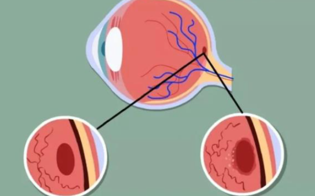 黄斑水肿手术能彻底治好吗？病情轻容易治好,病情重拖得久治好较难