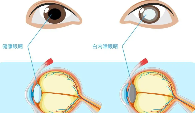 西安白内障免费政策新消息！哪些人能享手术免费，申请条件有哪些？