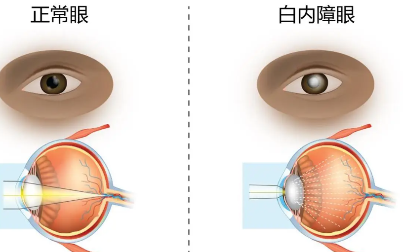西安白内障手术风险与禁忌