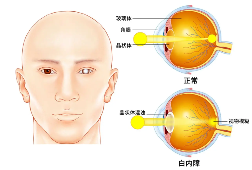 西安白内障免费政策申请条件