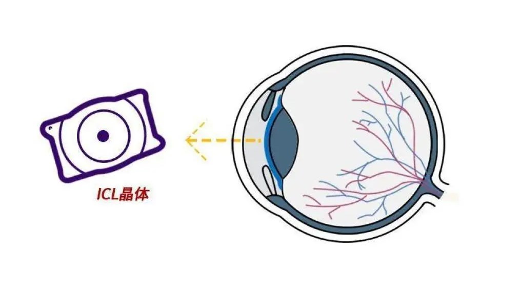 关于广州市做眼睛飞秒近视手术的医院的收费情况