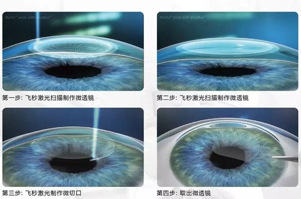 芜湖近视手术全飞秒16800元，分享我做的价格明细表