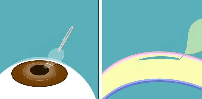 大连何氏武海涛全飞秒怎么收费?www.89yo.com