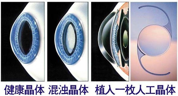眼部人工晶体置换手术选院的核心参考维度www.89yo.com