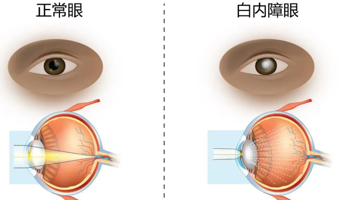   
恩施慧宜眼科白内障手术费用合理吗？过来人分享真实花费