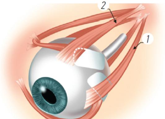 一、 段安丽后巩膜加固术怎么样？www.89yo.com