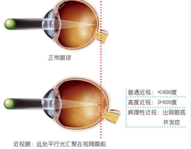 四、 段安丽后巩膜加固术术前必读：哪些人较适合找段安丽做手术？