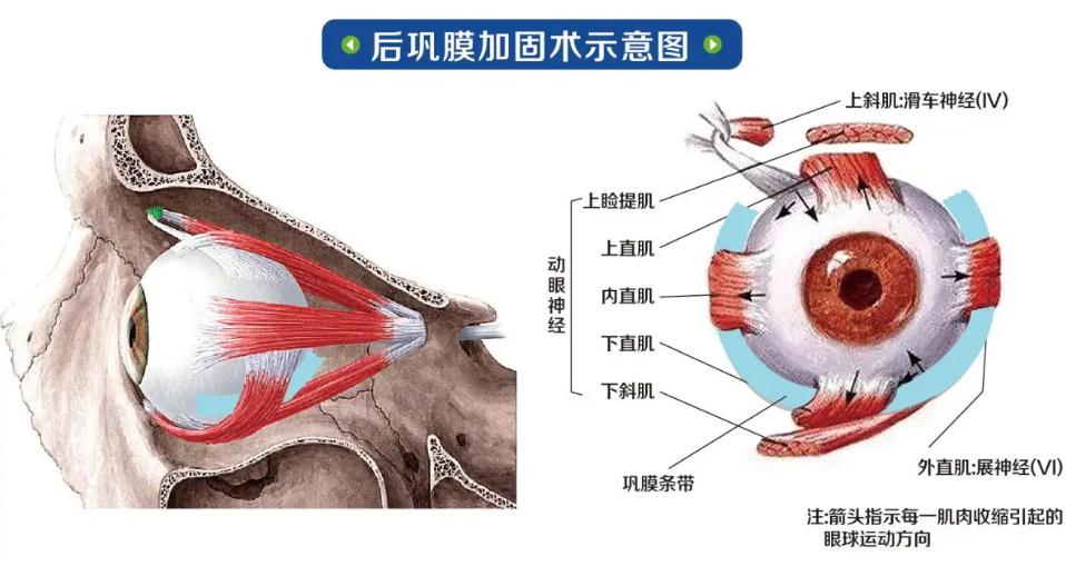 二、 段安丽后巩膜加固术不坑人！三点证据让您放心