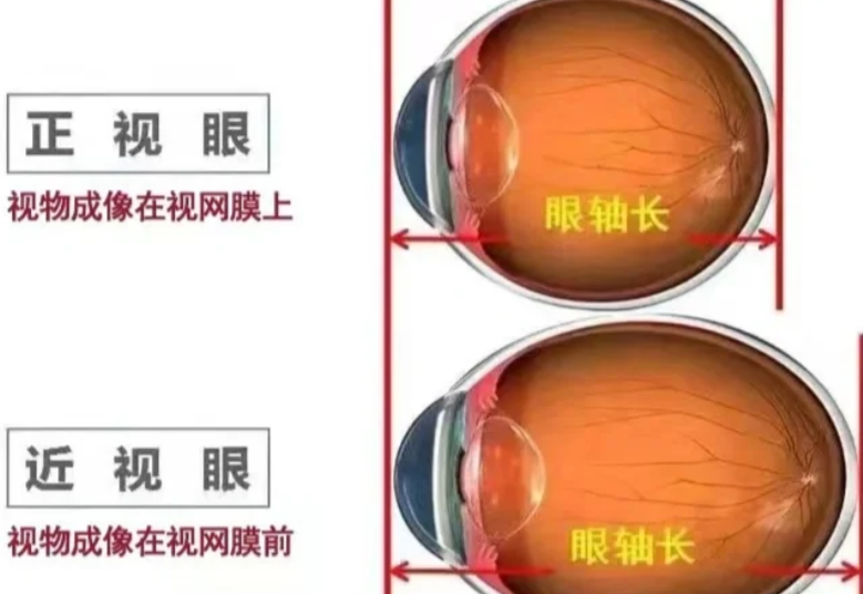 五、 近视手术避坑指南：价格不是只有这一个标准