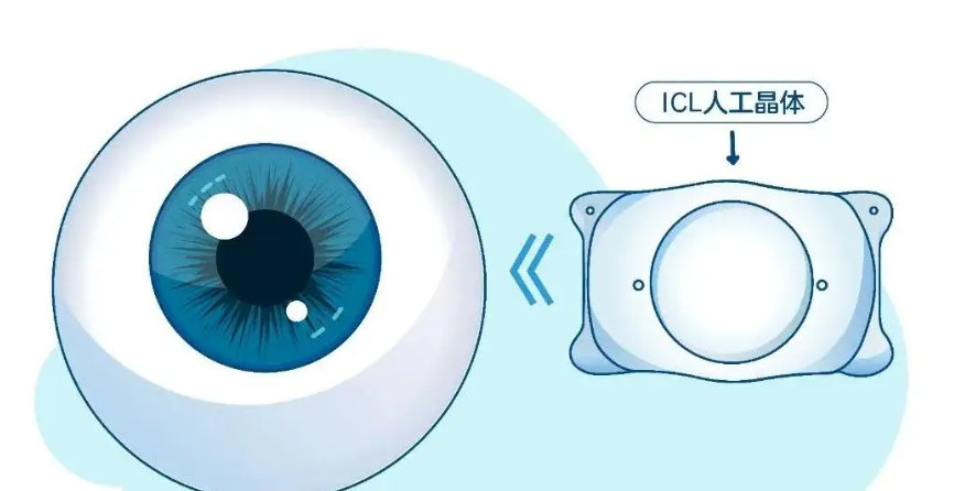爱尔眼科ICL晶体植入疼不疼？2026技术升级：导航定位+10分钟速成，全程无痛，术后当天就能睁眼！