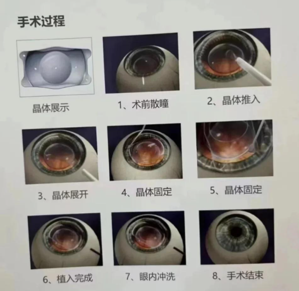 二、爱尔眼科ICL晶体植入手术流程与体验解析www.89yo.com