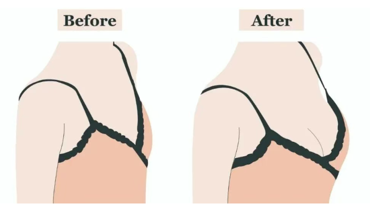 陈星光隆胸价格表：傲诺拉闪耀假体隆胸约6万起，手术费、麻醉费和住院费全包无加项