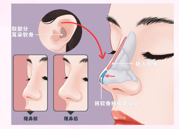 杨万忠海鸥线隆鼻实例真绝了！打造自然妈生感鼻型，术后变好期也快