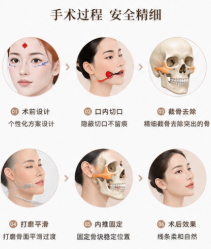 李继华磨骨技术口碑到底好不好？亲测用户反馈：技术稳风格自然，6000+例手术经验，坐诊四川友谊