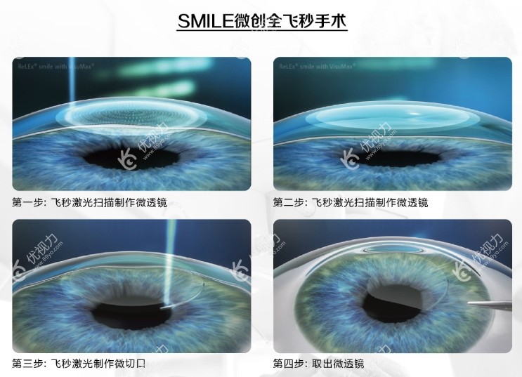 当兵做近视眼手术一般做什么手术