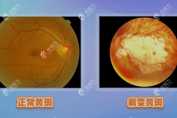 黄斑病变的预防措施