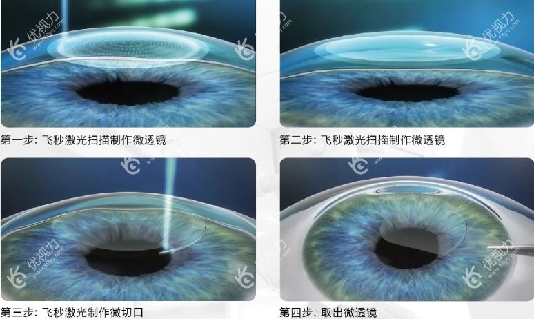 全飞秒激光手术恢复期是多久