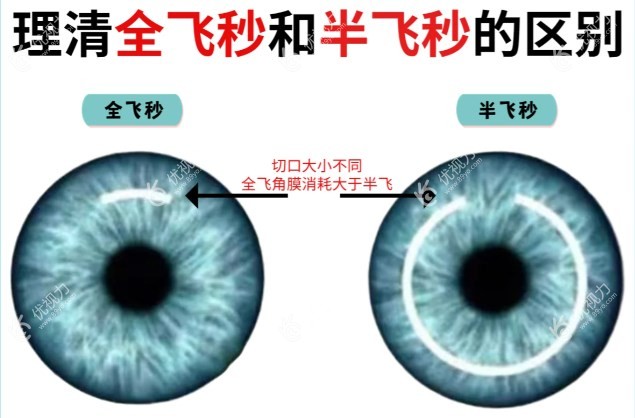 看半飞秒和全飞秒近视手术区别