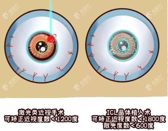 两个眼睛度数不一样可做近视手术89yo.com