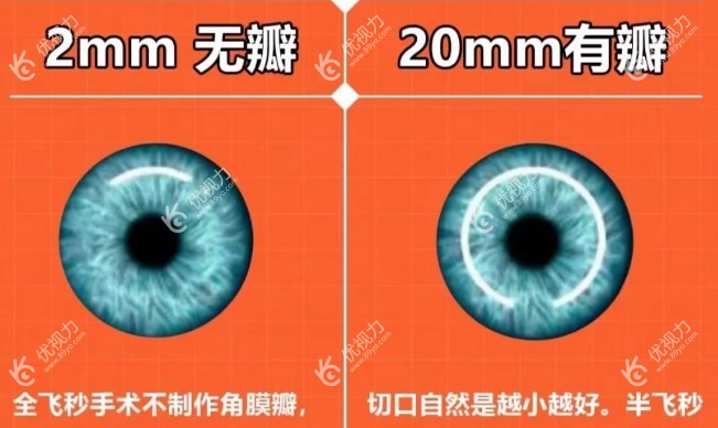 半飞秒和全飞秒近视手术