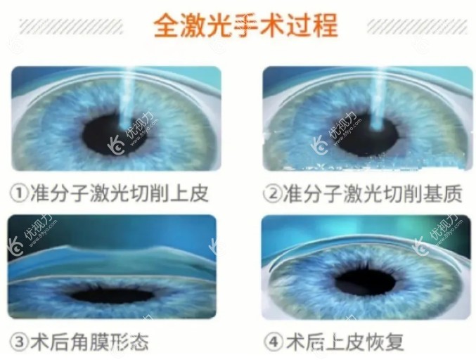 全激光手术