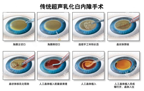 白内障手术示意图图片