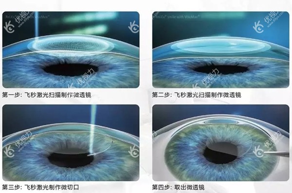 尹海泉医生可开展多种近视手术方式