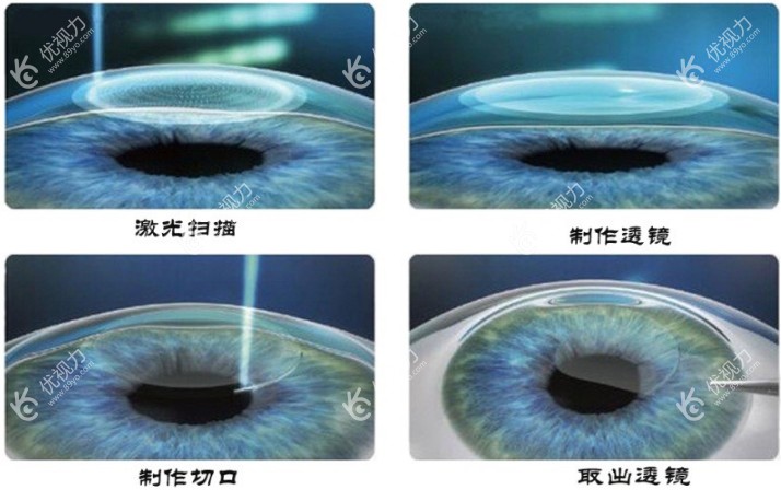 佛山华厦眼科做全飞秒激光近视手术