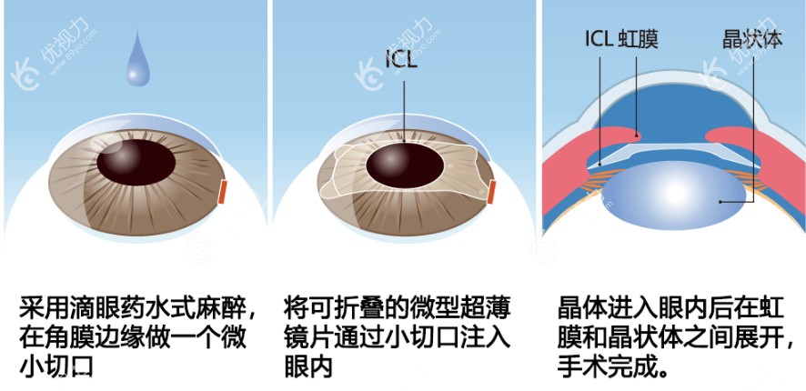 连云港爱尔眼科做人工晶体ICL植入手术过程