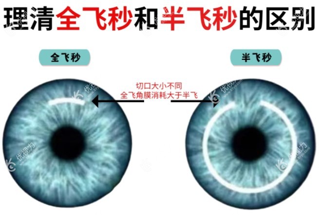 半飞秒和全飞秒手术区别89yo.com