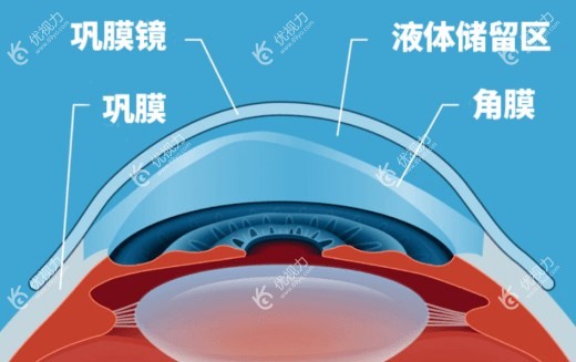 全飞秒激光手术角膜厚度要求多少