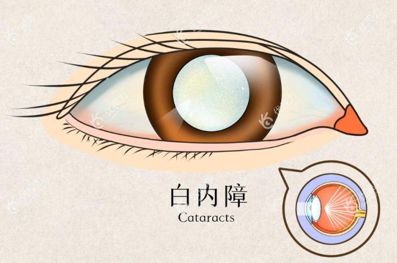 白内障手术
