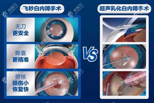 飞秒白内障和普通白内障手术的区别