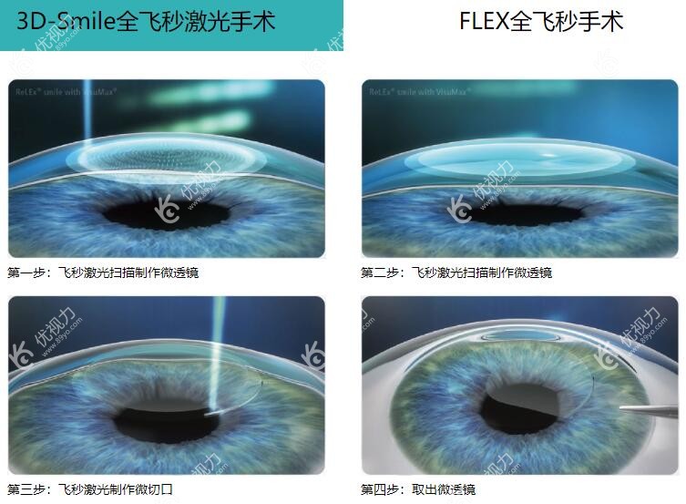 全飞秒激光近视手术示意图