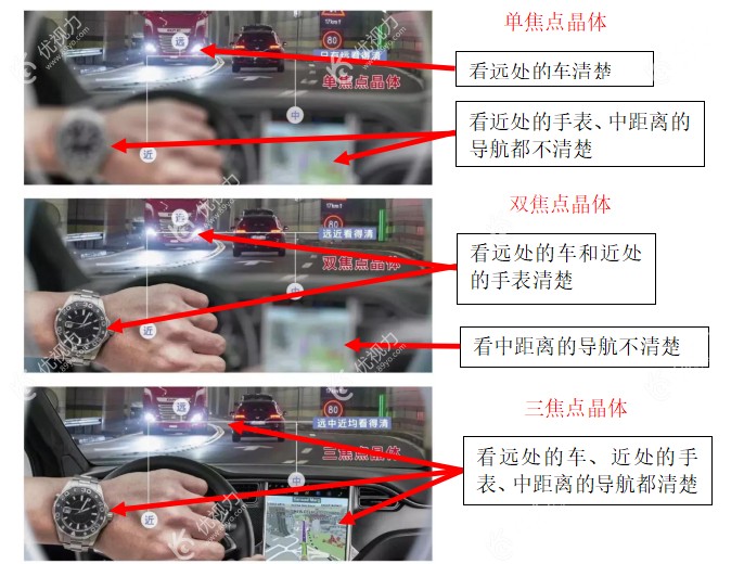 白内障三焦晶体植入手术技术成熟吗