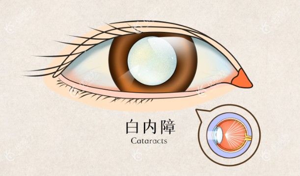 白内障三焦晶体手术成熟吗
