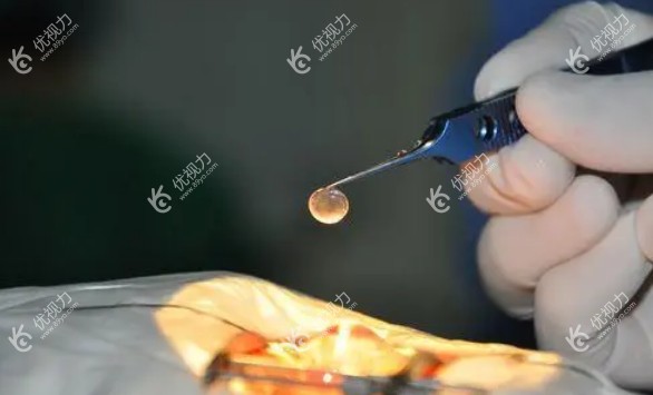 角膜移植手术需要多少钱一只眼睛?角膜移植手术费用一般在8000-3万元左右一只眼睛