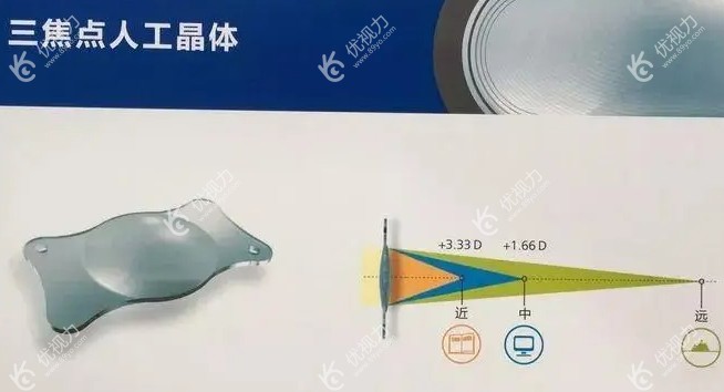 白内障三焦晶体植入手术后遗症
