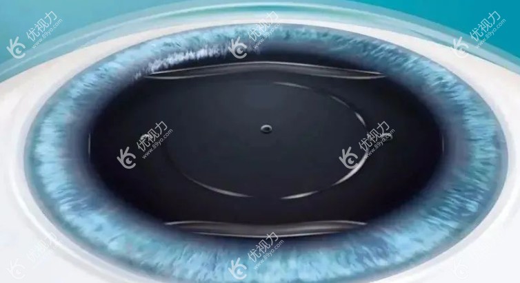 广西医科大学第一附属医院眼科开展白内障晶体植入手术