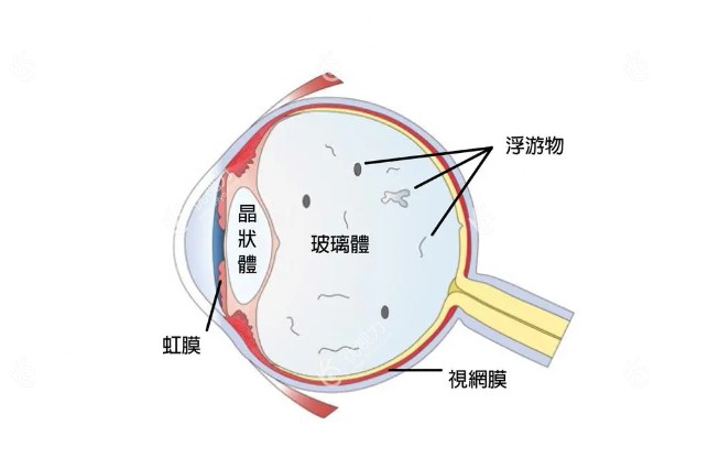 飞蚊症眼球的构造
