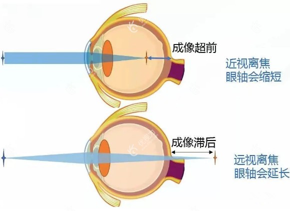 4L疗法对治疗近视真的有用吗www.89yo.com