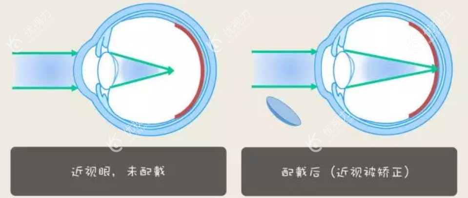 近视眼和佩戴ok镜后