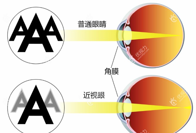 近视眼