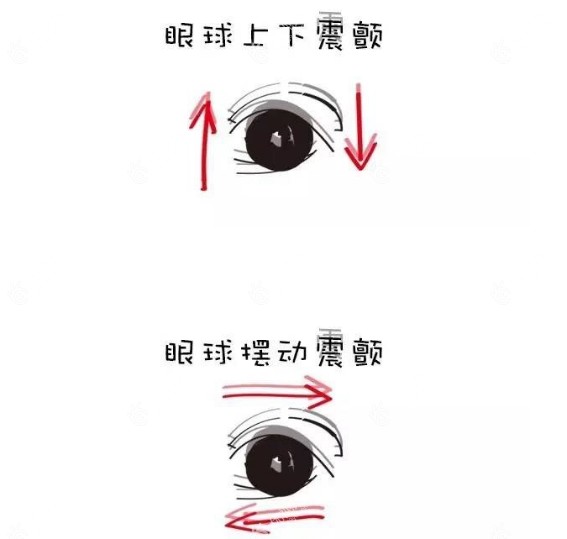 眼球震颤是怎么回事www.89yo.com