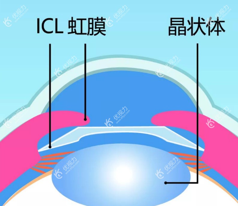 晶体植入手术示意图