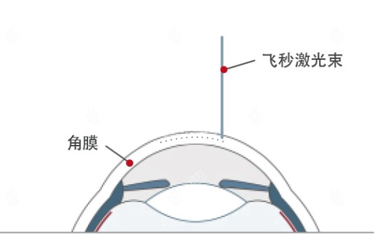 飞秒激光手术可以达到1.0吗