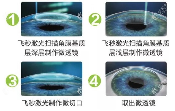 飞秒手术能恢复到1.0吗