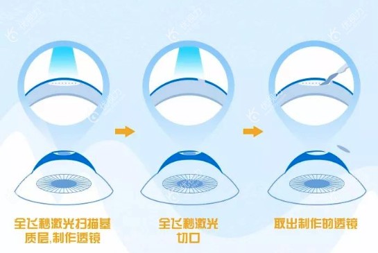 做完飞秒手术以后两个眼睛都能到1.0以上吗www.89yo.com