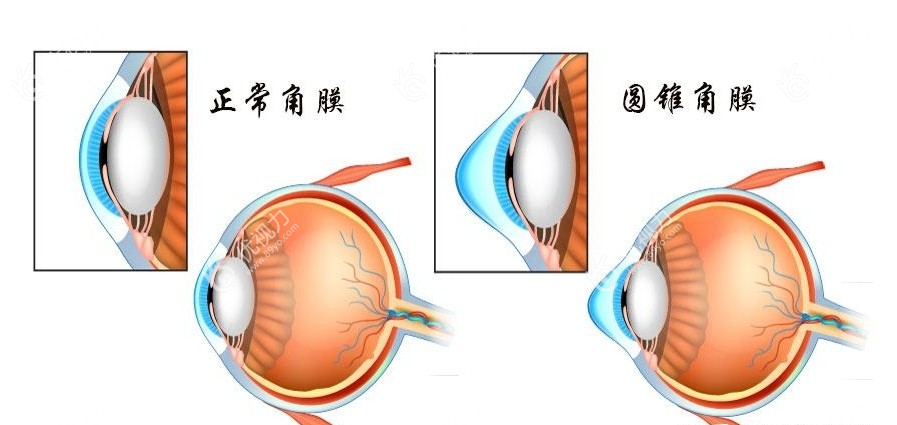 圆锥角膜与正常角膜对比